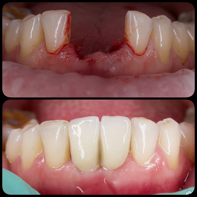 Implantologie dentara - Estetica dentara - Protetica dentara - Implanturi dentare